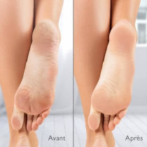 Râpe électrique anti-callosités Silk'n Vacupedi avec aspiration int